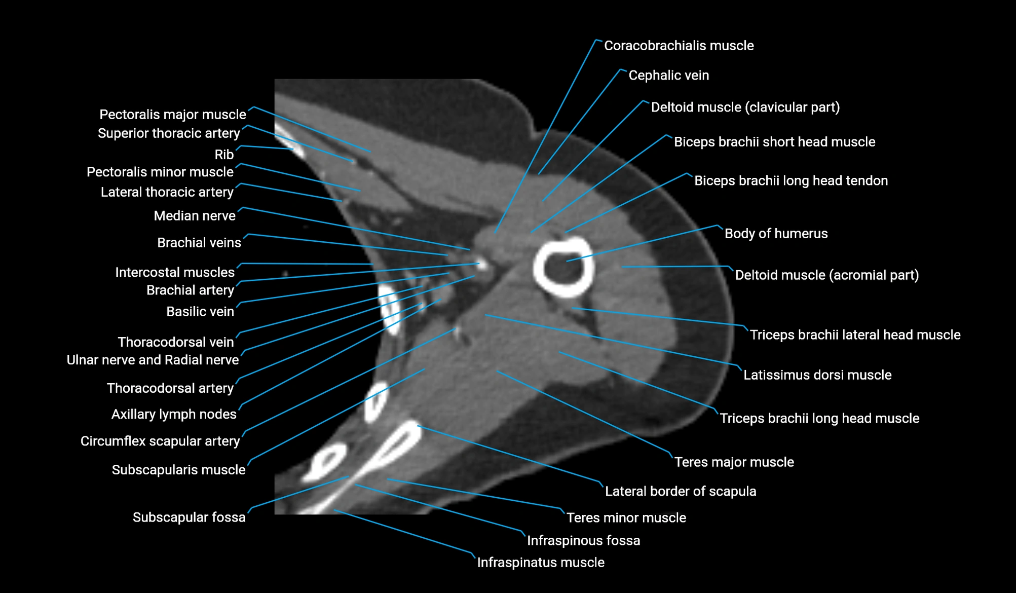 CT upper arm axial  cross sectional anatomy labelled radiology image -00142.webp